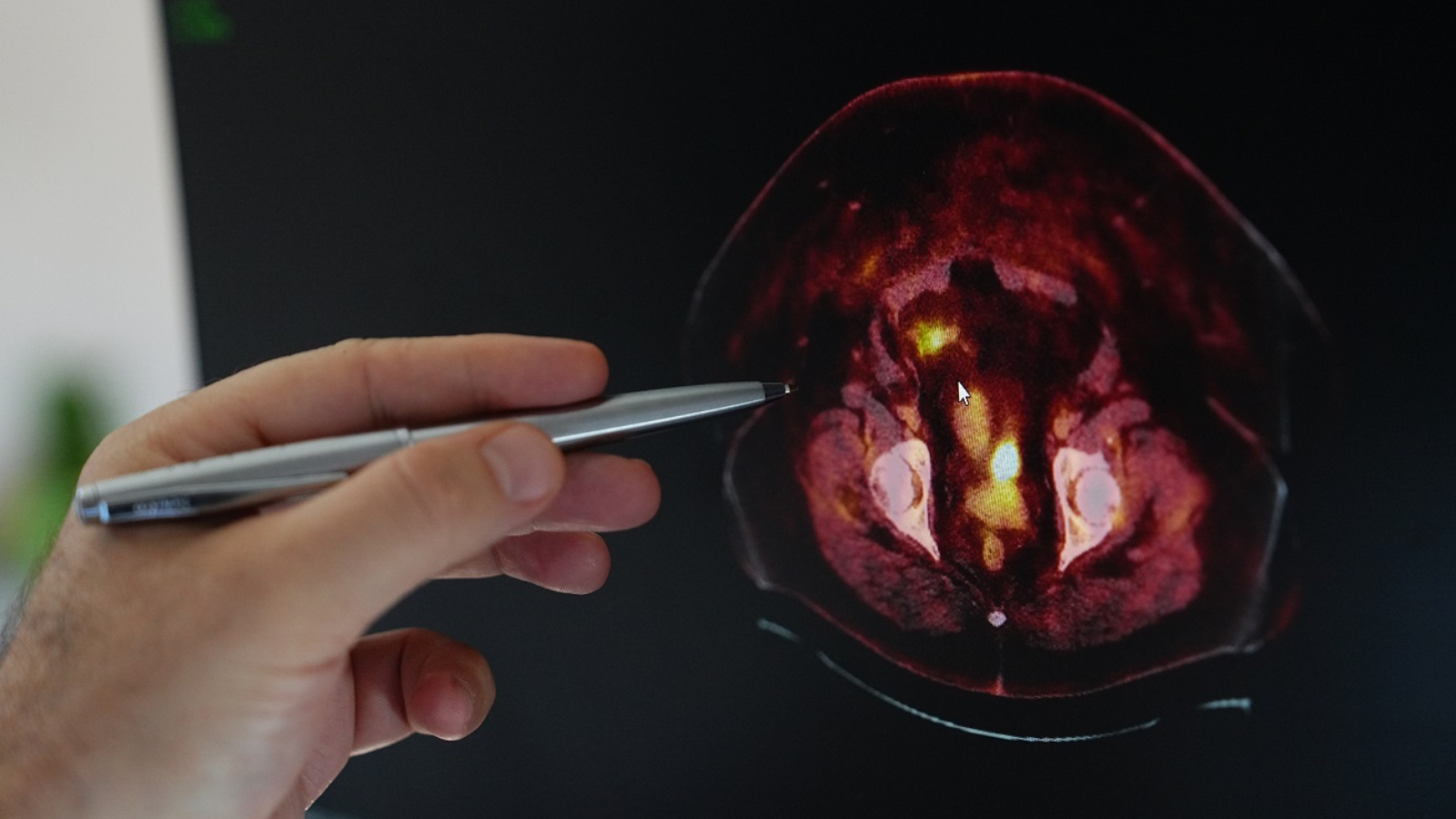 uzmanindan kadinlara kritik uyari obezite rahim kanseri riskini artiriyor z8vWTQIr